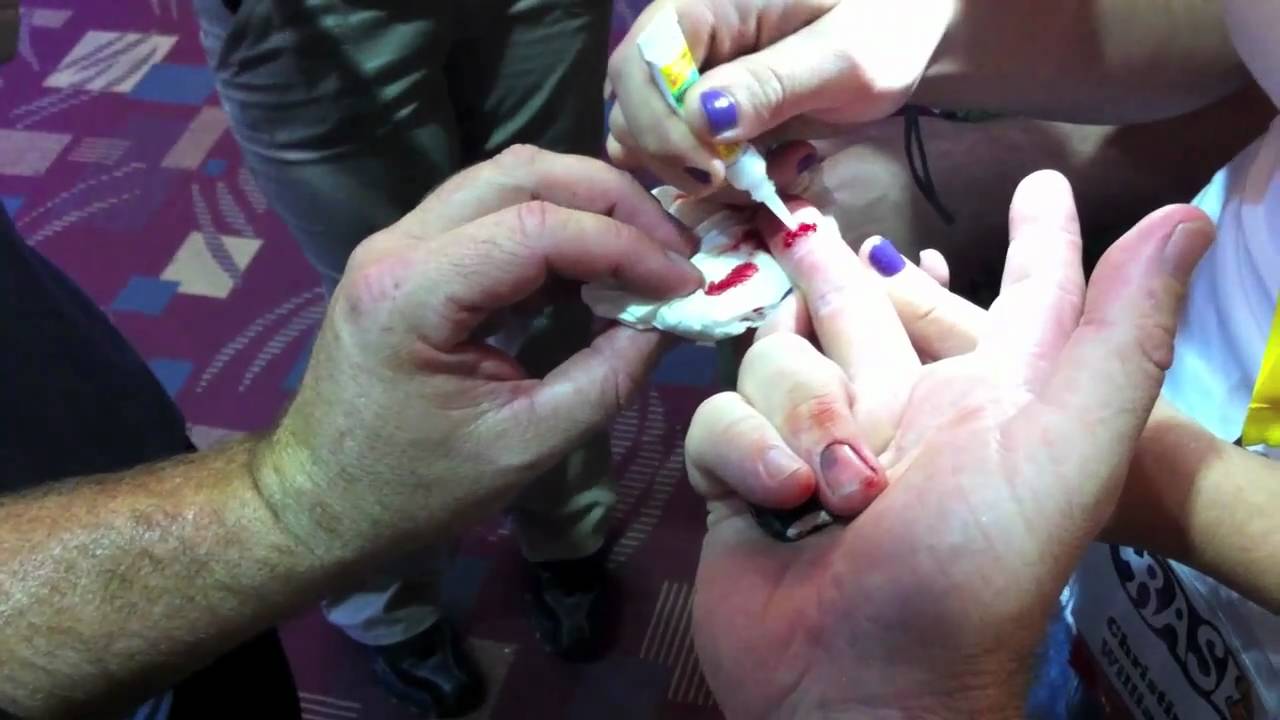 Super-Glue-For-Cuts-Medical-Uses-Crazyglue2