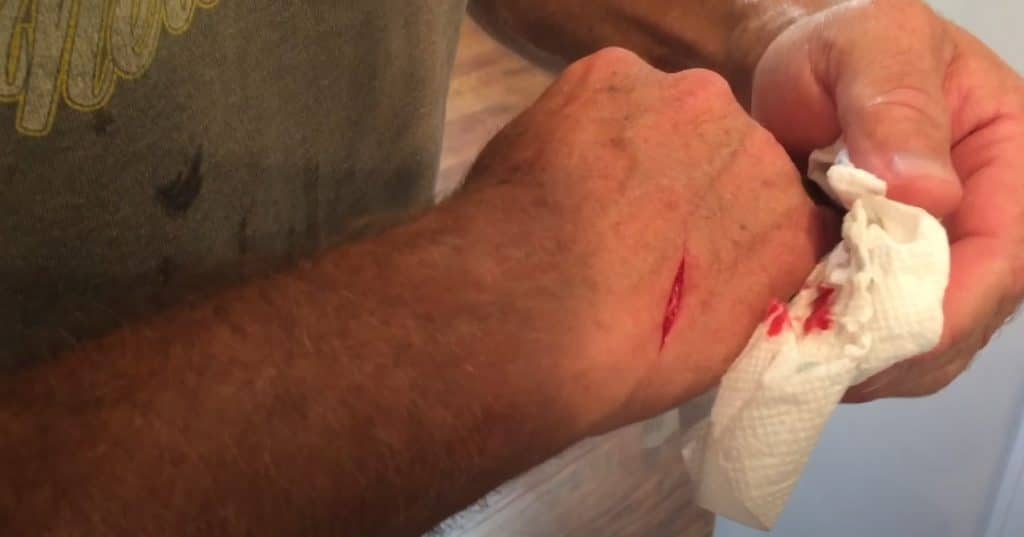 Types Of Wounds Butterfly Stitches Are Suitable For